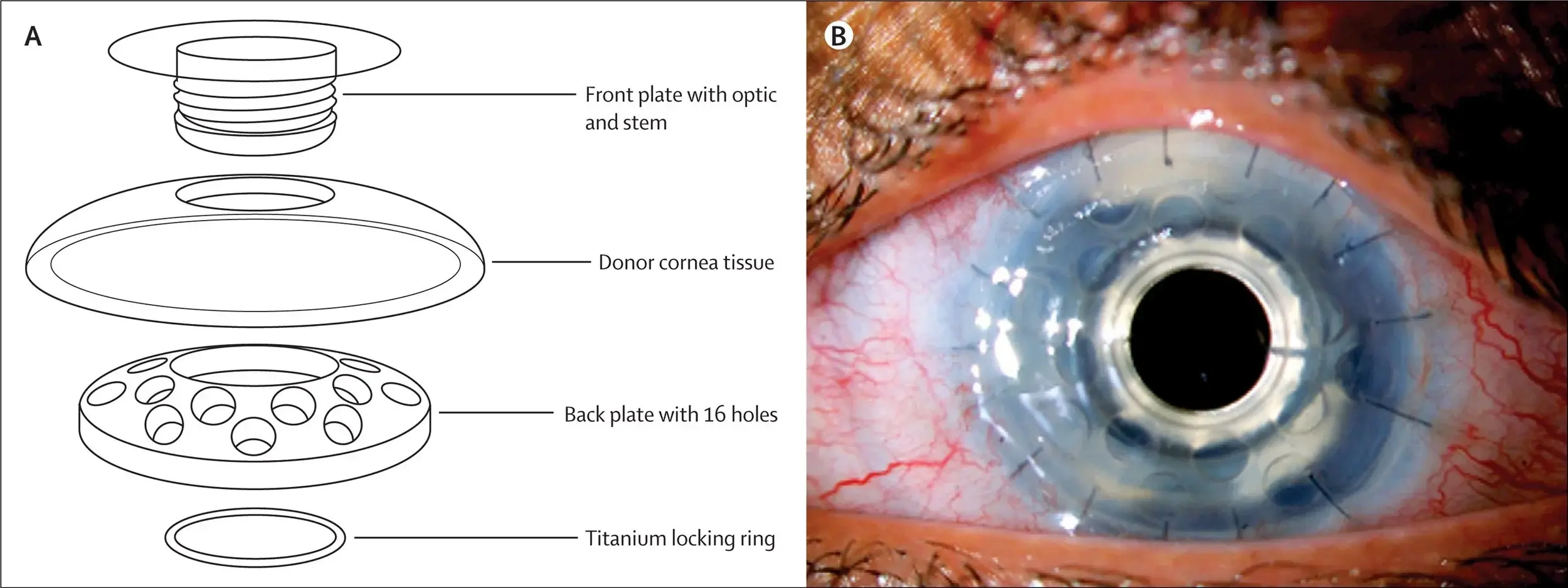A diagram shows parts of an artificial cornea implant on the left; on the right, a close-up photo displays the implant placed in a human eye, as seen by an expert cornea surgeon Brisbane, surrounded by stitches and blood vessels.