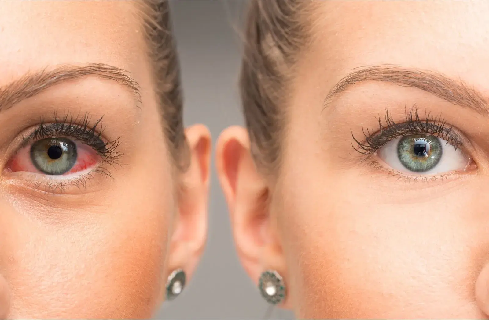 Side-by-side comparison of irritated eye and healthy eye.