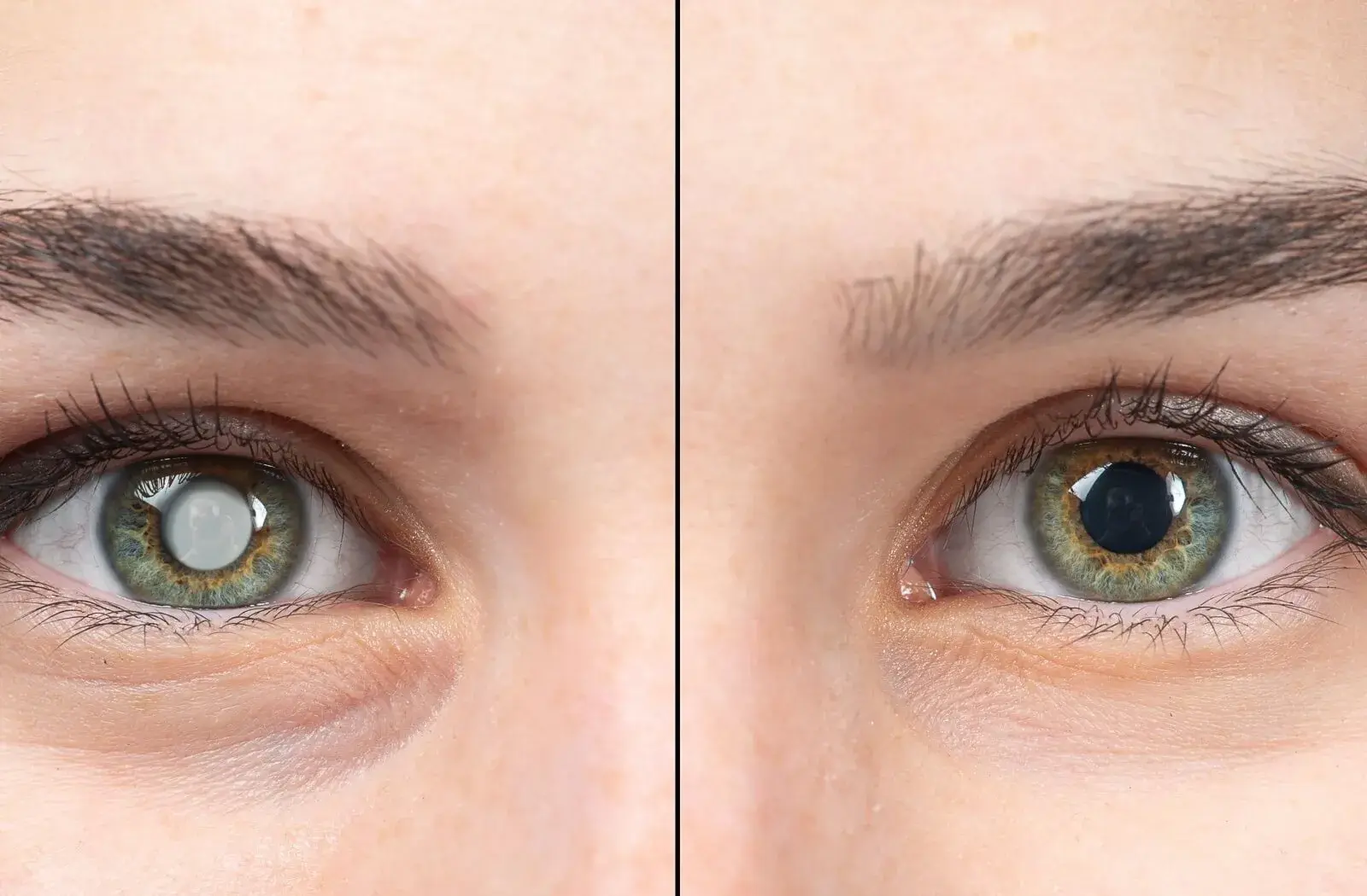 Comparison of an eye with cataract (left) and after surgery (right).