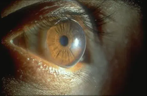 Close-up of a brown eye showing corneal deformation.