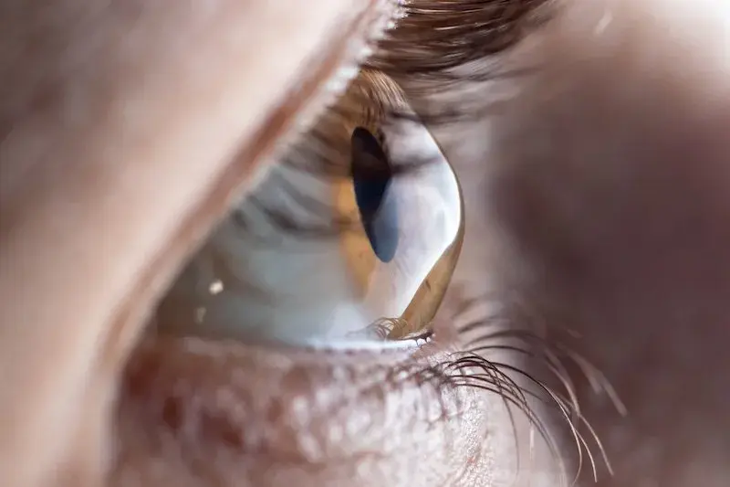 Close-up of a human eye displaying corneal distortion.