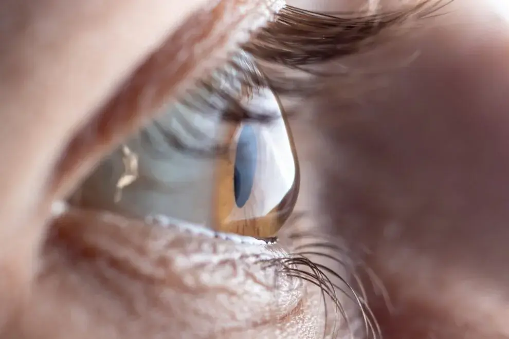 Close-up of a human eye showing keratoconus with visible corneal distortion.