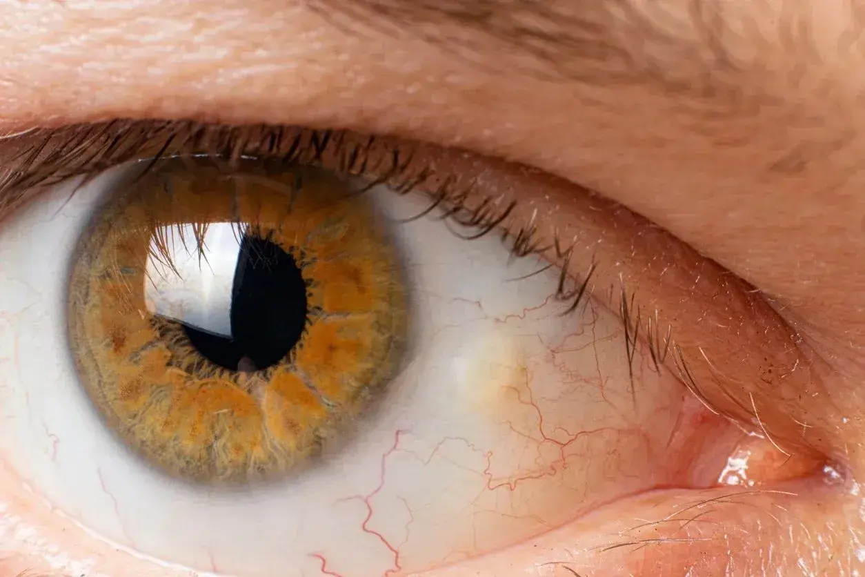 Close-up of a human eye showing golden iris, dark pupil, and visible veins.