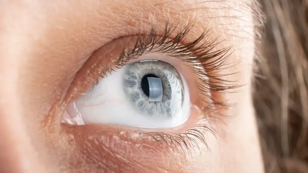Close-up of a human eye showing keratoconus with visible corneal distortion.