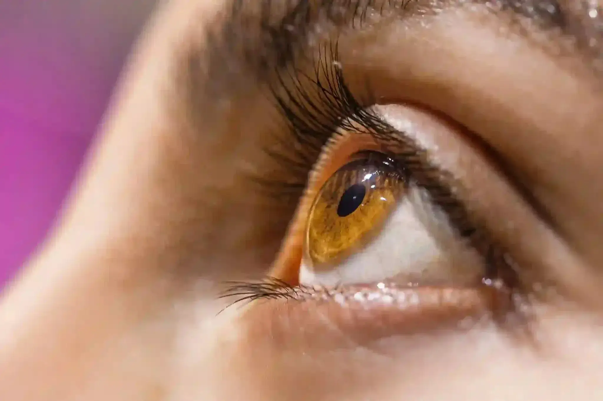 Close-up of a human eye showing characteristic features of keratoconus.