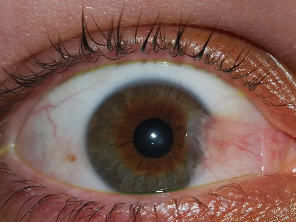 Closeup of a human eye showing pterygium with redness and vascularization.
