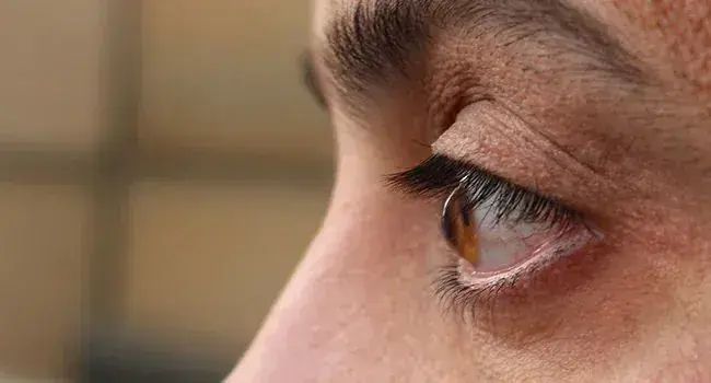 Closeup of a human eye with visible keratoconus symptoms.