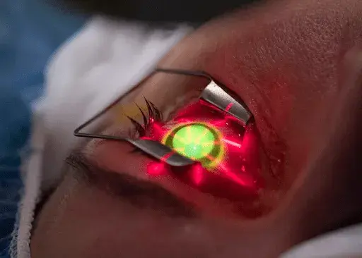 Close-up of an eye undergoing corneal collagen cross-linking with a laser applied.