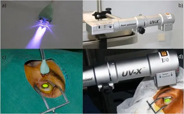 Devices and procedures for corneal cross-linking, including UV light application.