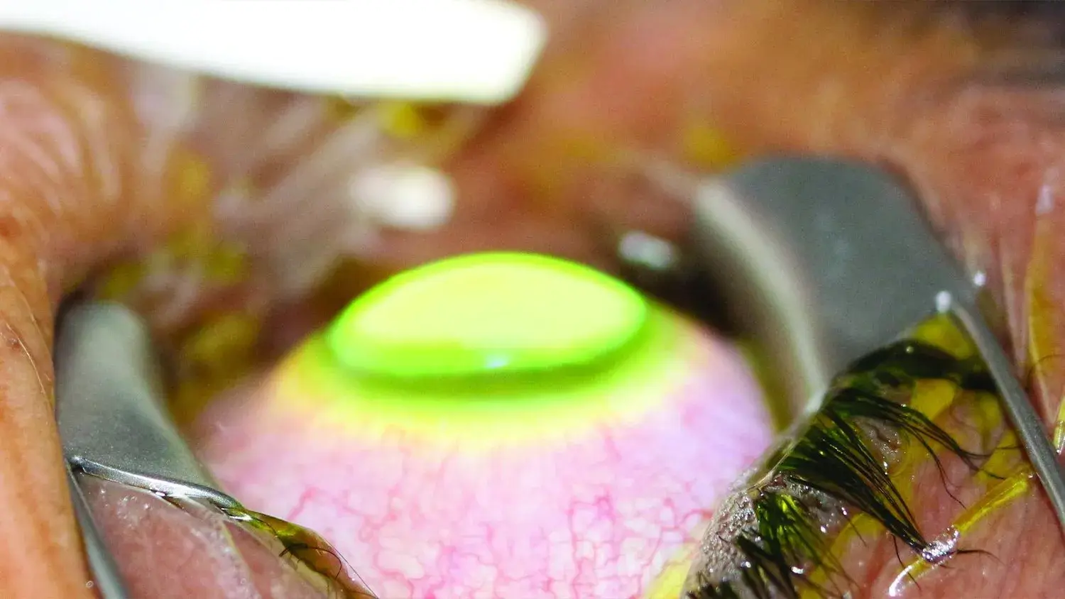 Close-up of an eye undergoing corneal collagen cross-linking treatment.