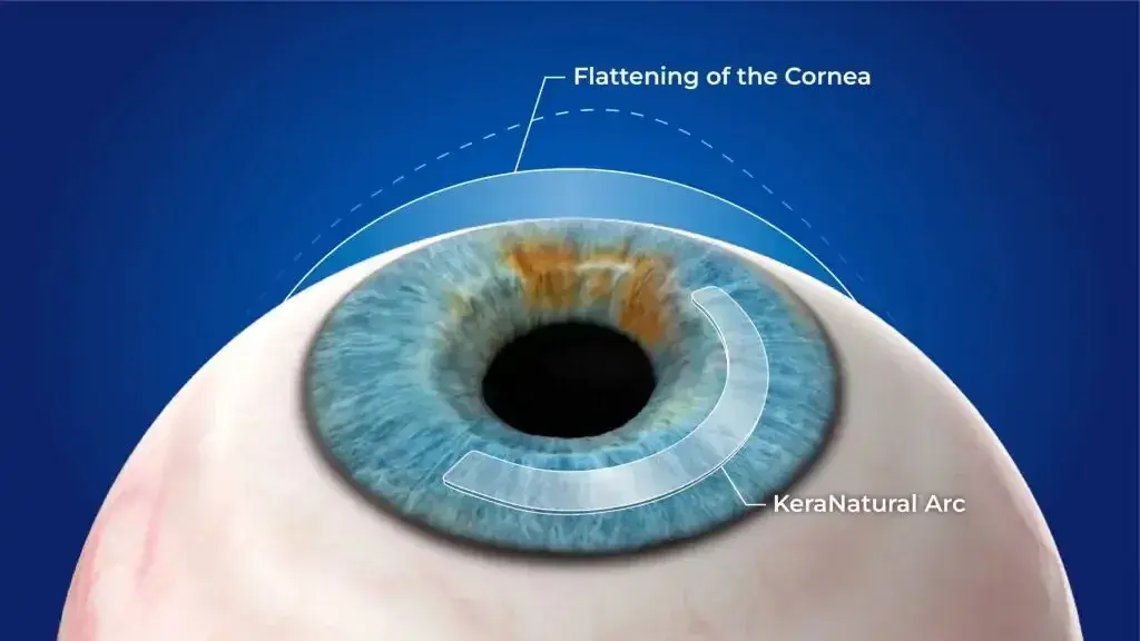Illustration of a cornea showing flattening and KeraNatural Arc segments.