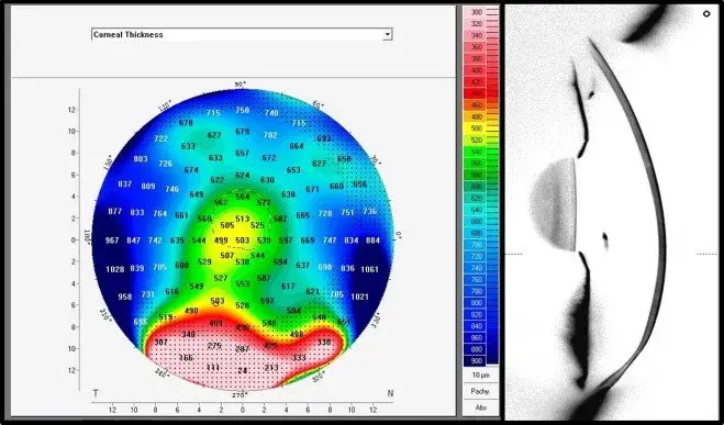 Corneal thickness map with numerical values and cross-sectional slice view.