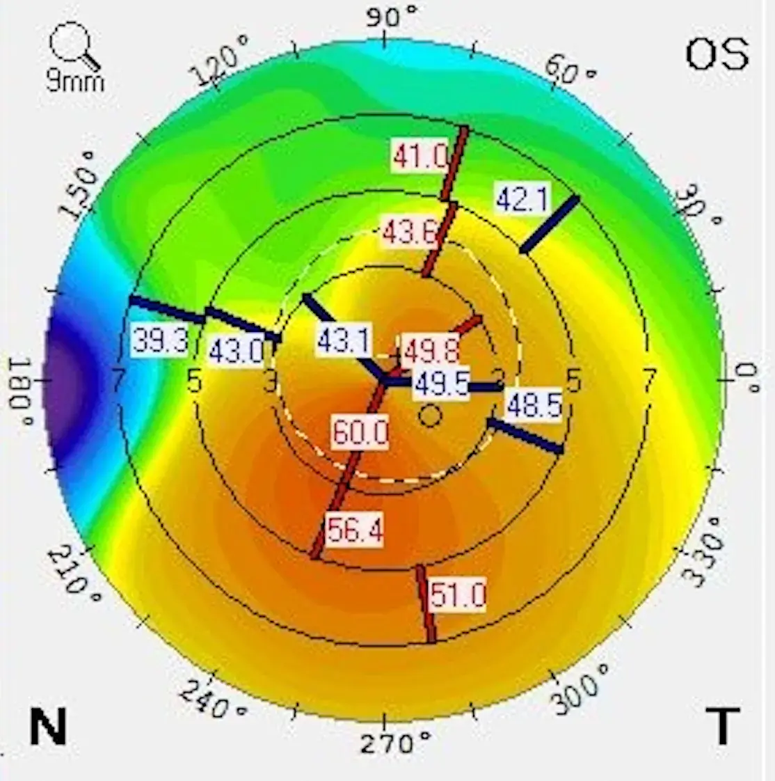 Corneal topography map of a left eye with keratoconus, showing the steepest area in red and orange below the centre of the cornea where the cone sits