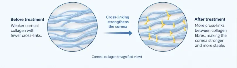 Diagram of corneal collagen before and after cross-linking, showing extra cross-links between the fibres after treatment