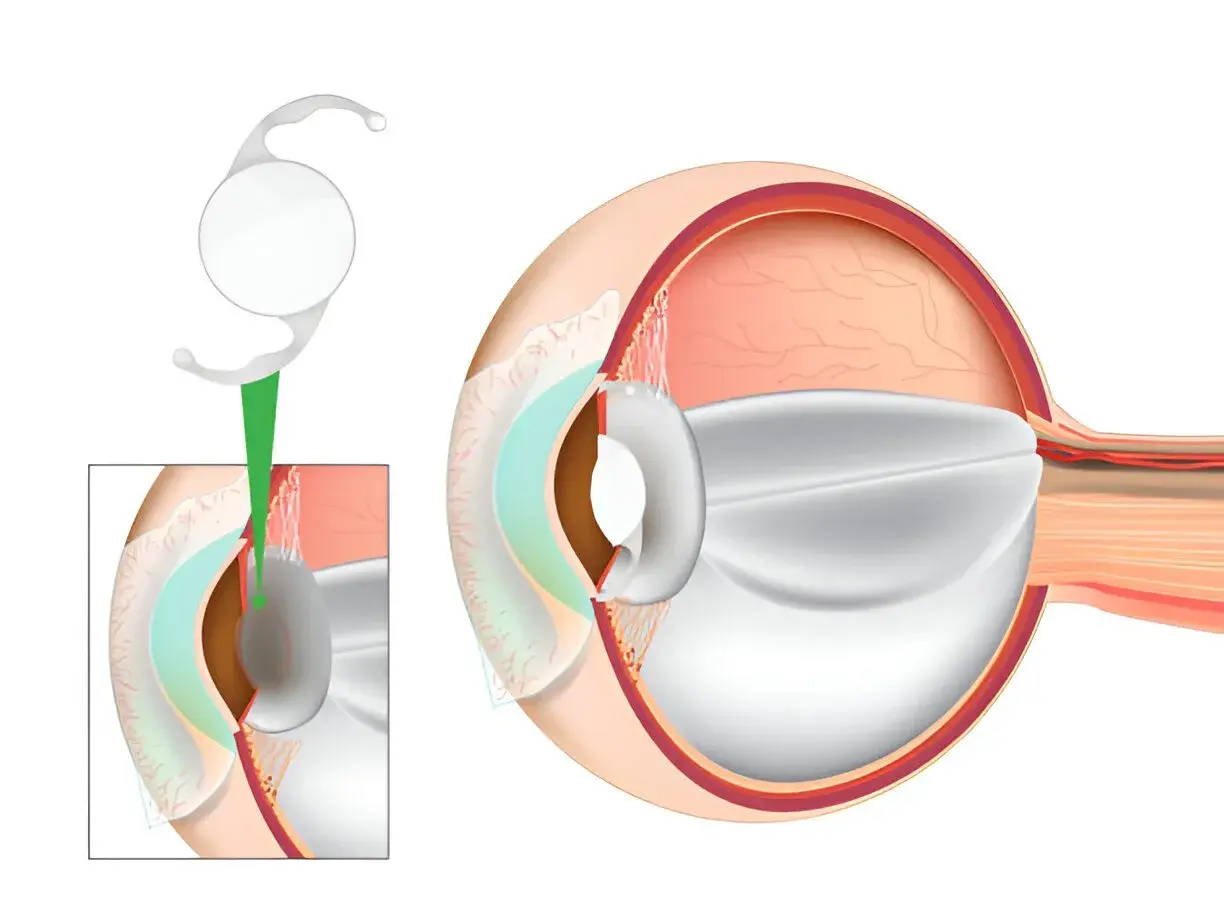 Illustration of eye anatomy showing IOL lens insertion.