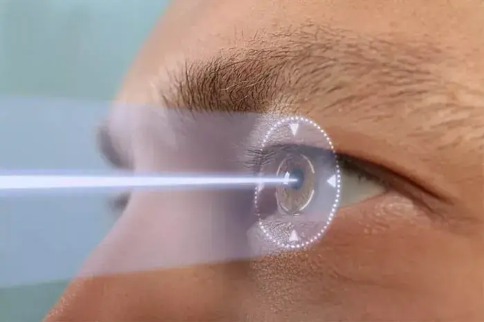 Illustration of laser surgery targeting the eye for refractive correction.