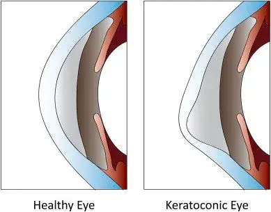 Comparison of a healthy eye and a keratoconic eye structure.