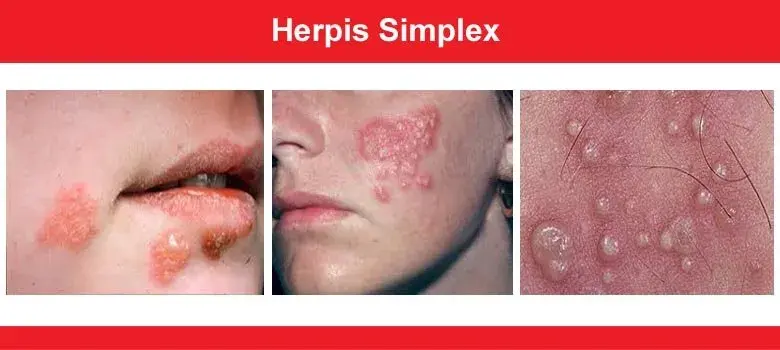 Close-up images of herpes simplex skin lesions on lips and face.