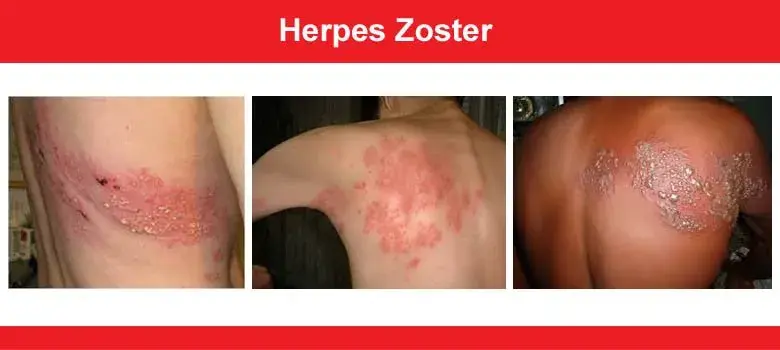 Multiple views of skin rashes caused by Herpes Zoster.
