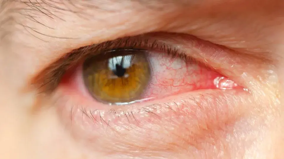 Close-up of an inflamed eye showing redness and irritation.