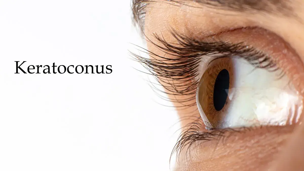 Close-up of an eye showing signs of keratoconus.