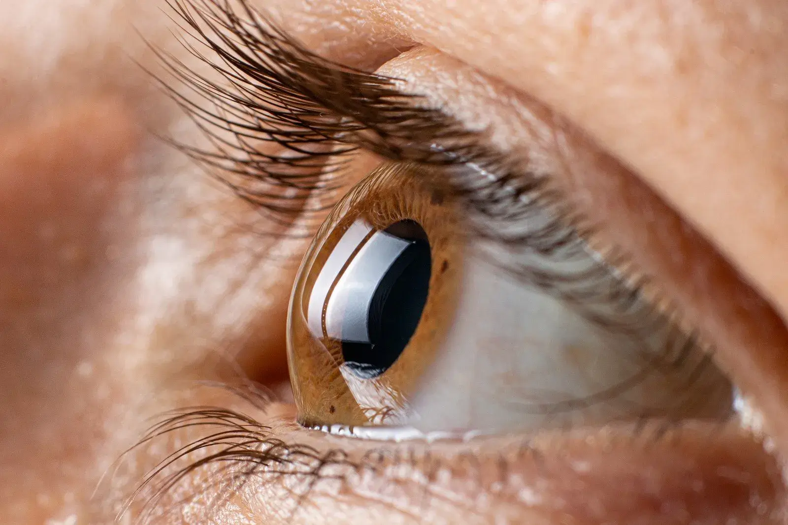 Close-up of an eye with a keratoconus cornea, showing detail and reflections.