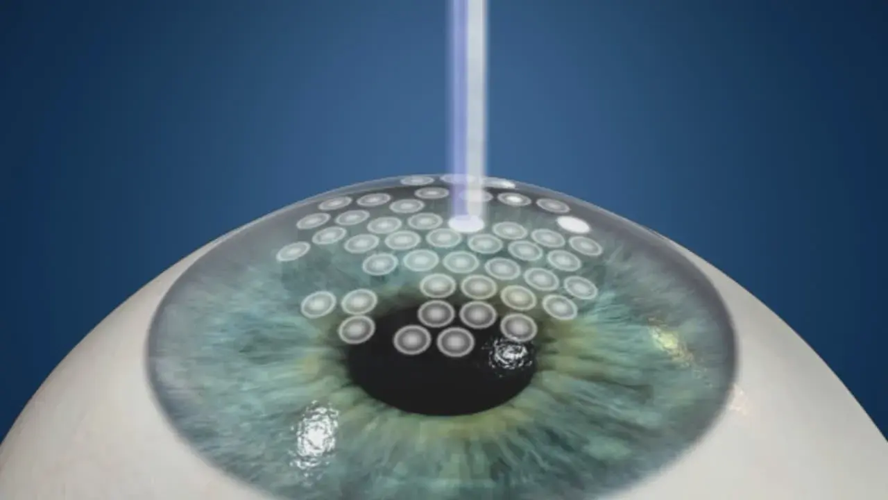 Illustration of laser surgery on an eye affected by keratoconus.