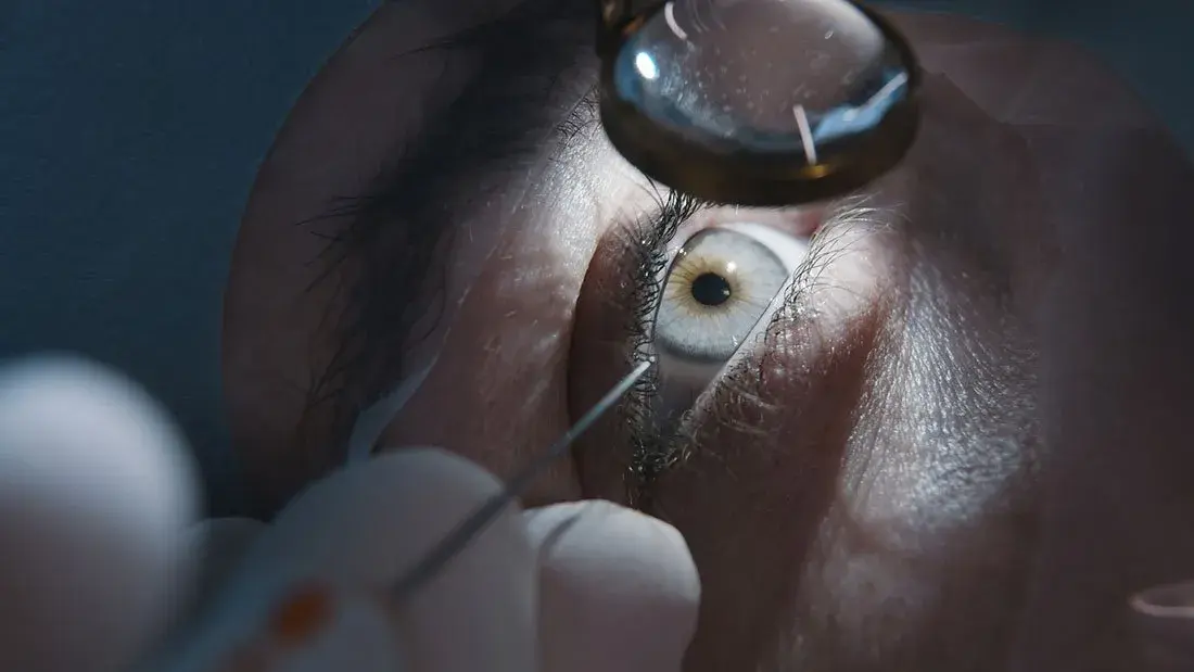 Close-up of an eye being examined during a keratoconus laser surgery procedure.