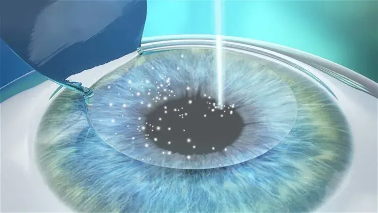 Illustration of laser eye surgery on a human eye with blue iris.