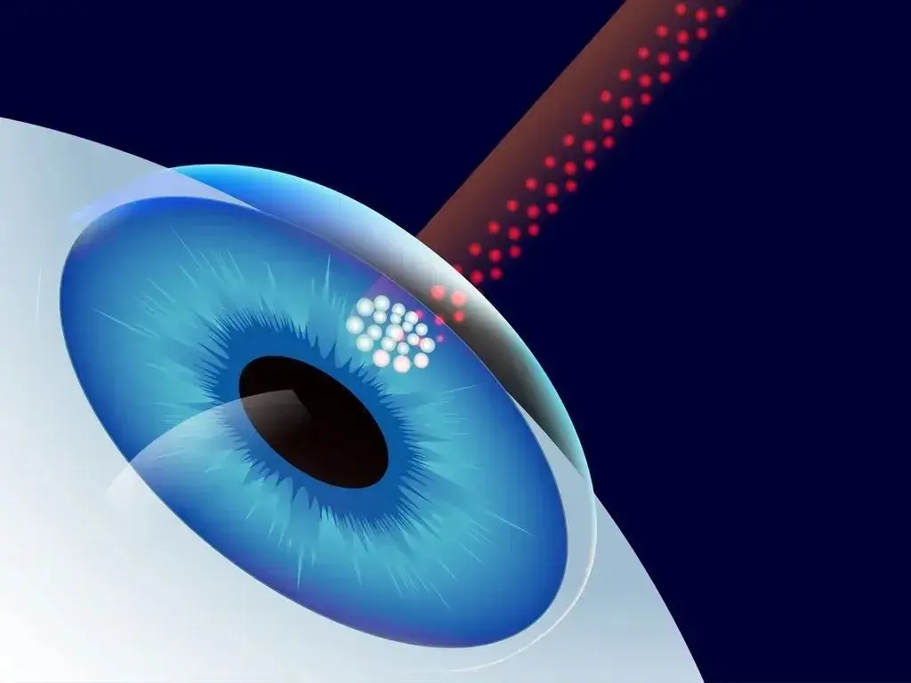 Illustration of an eye with a laser beam targeting its surface.