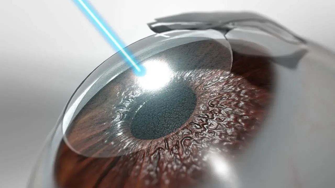 Laser treatment applied to an eye during a LASIK procedure.