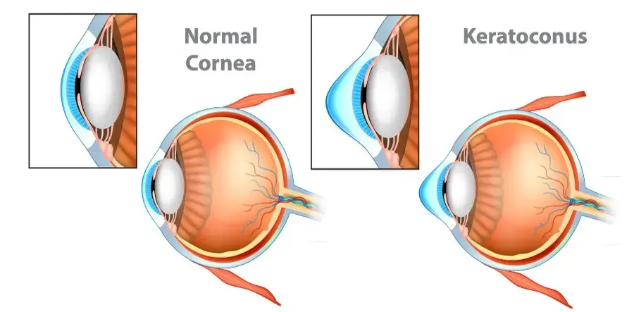 Comparison of normal cornea and cornea affected by keratoconus.