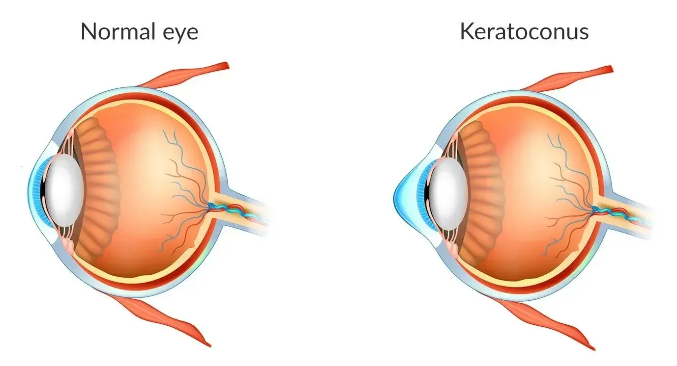 Comparison of a normal eye and an eye with keratoconus.