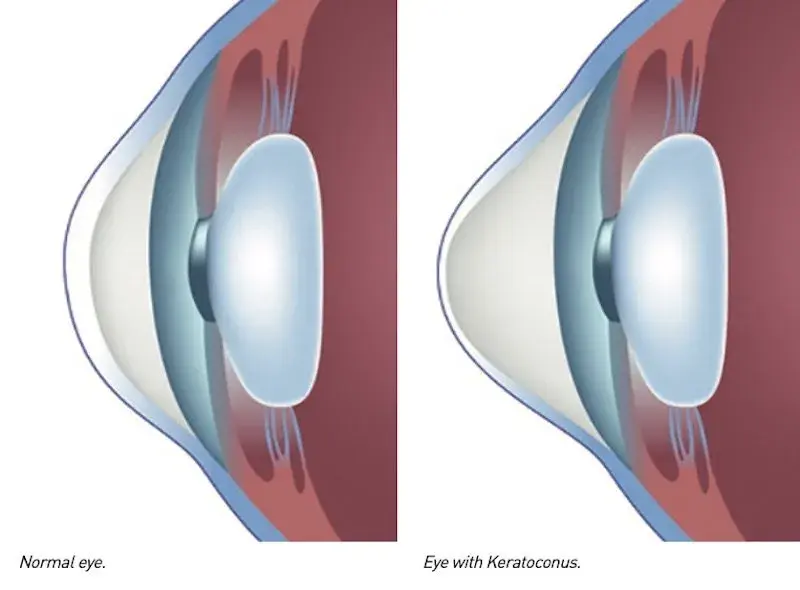 Comparison of a normal eye and an eye with keratoconus.