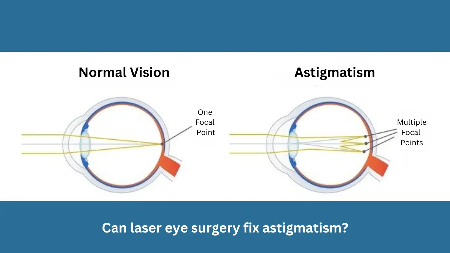 Diagram comparing normal vision and astigmatism with focal points.