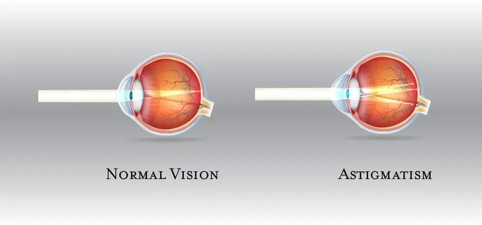 Illustration comparing normal vision and astigmatism in the eye.