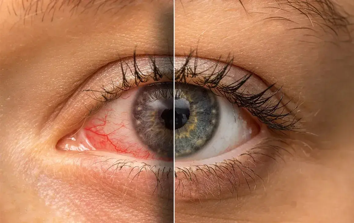 Comparison of a red irritated eye and a healthy eye.
