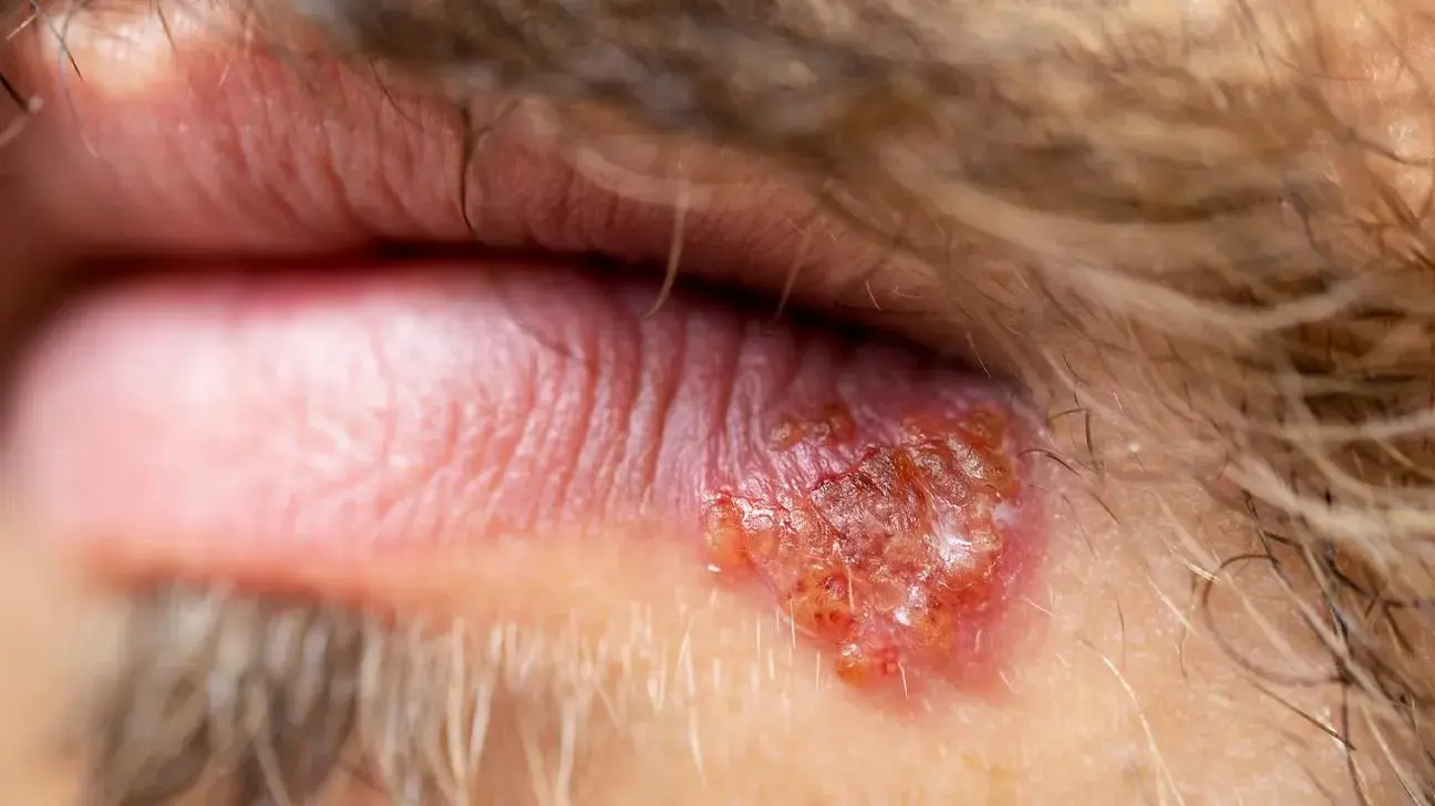Close-up of a skin lesion near the eye, indicative of oral herpes.
