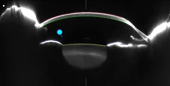 Pentacam imaging showing the shape and curvature of the cornea.