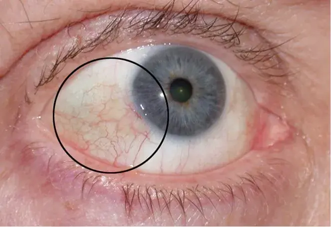 Closeup of an eye showing pinguecula, a yellowish growth on the conjunctiva.