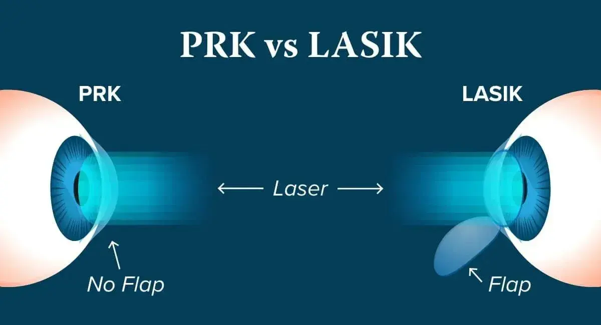 Illustration comparing PRK and LASIK eye surgery techniques.