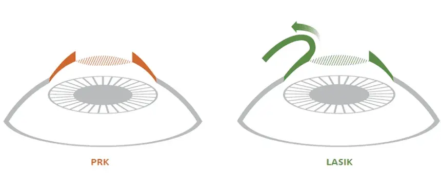 Diagram illustrating PRK and LASIK eye surgery techniques.