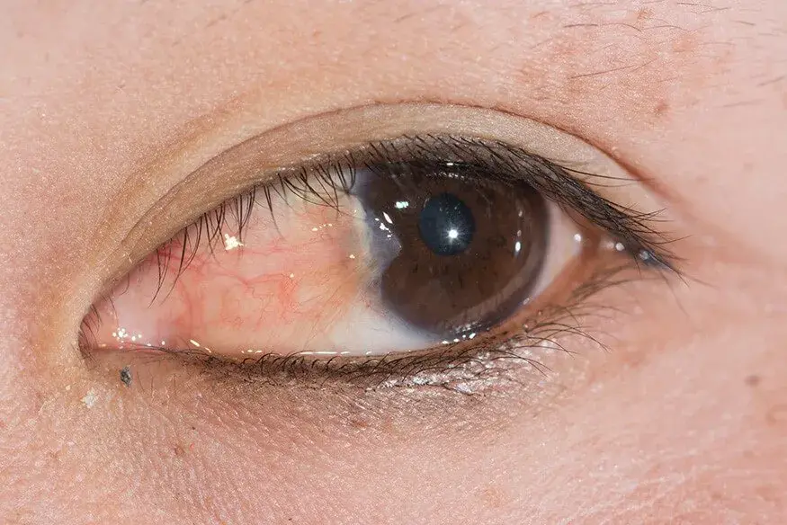 Close-up of an eye showing pterygium growth on the conjunctiva.