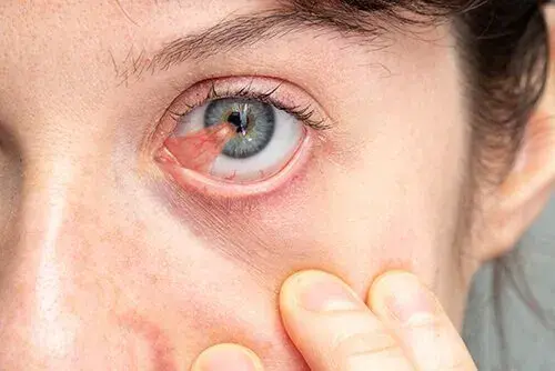 Close-up of a human eye showing pterygium growth with redness.