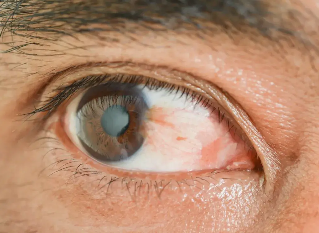Close-up of an eye showing pterygium and redness around the cornea.