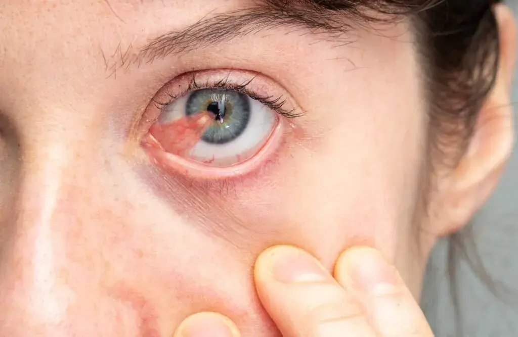 Close-up of a person's eye showing pterygium and irritation.