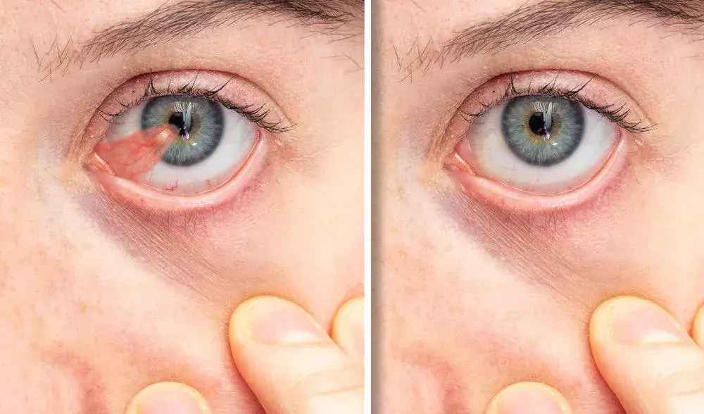 Close-up of an eye showing pterygium with before and after views.