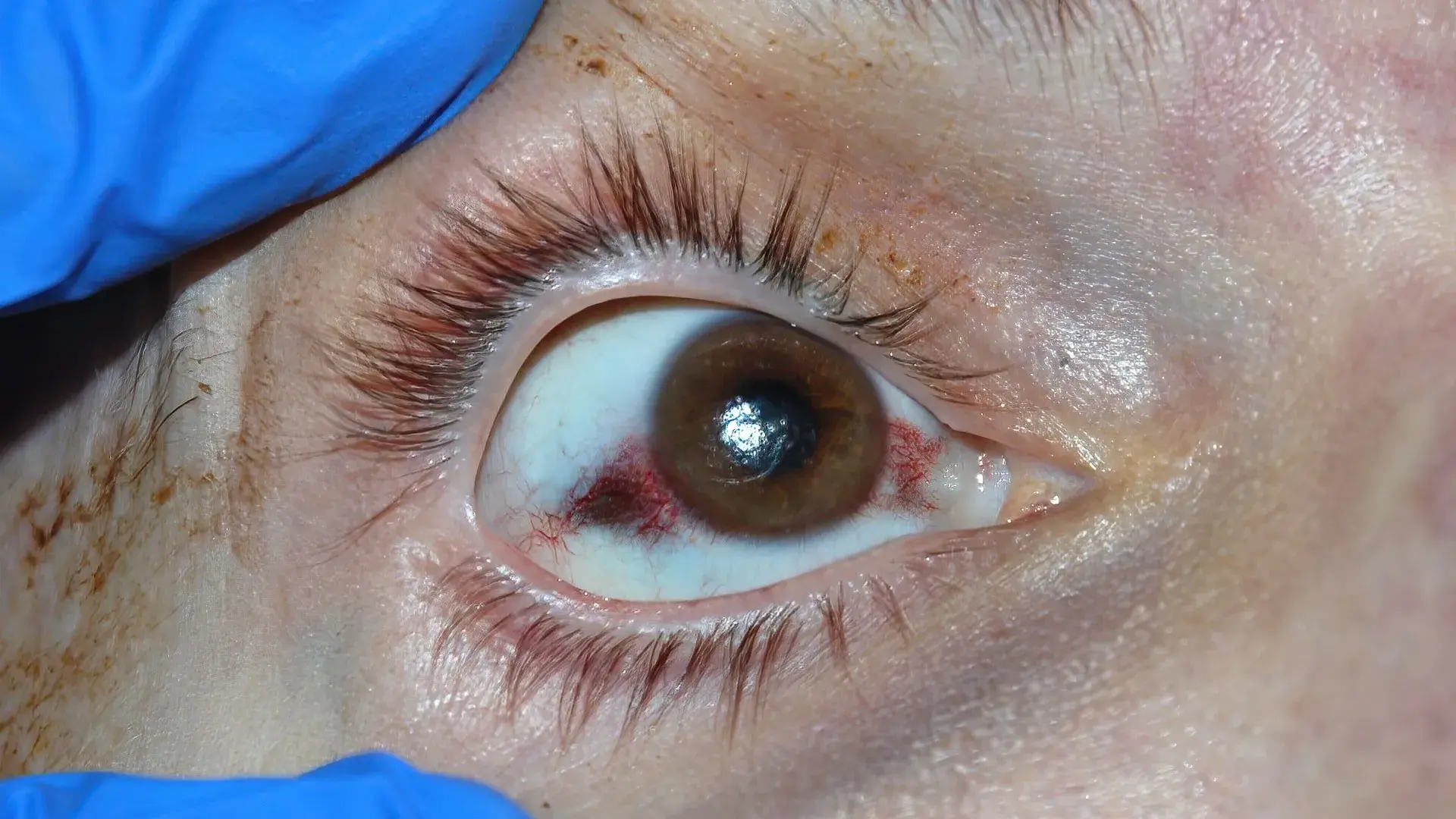 Close-up view of an eye showing pterygium post-surgery with redness.