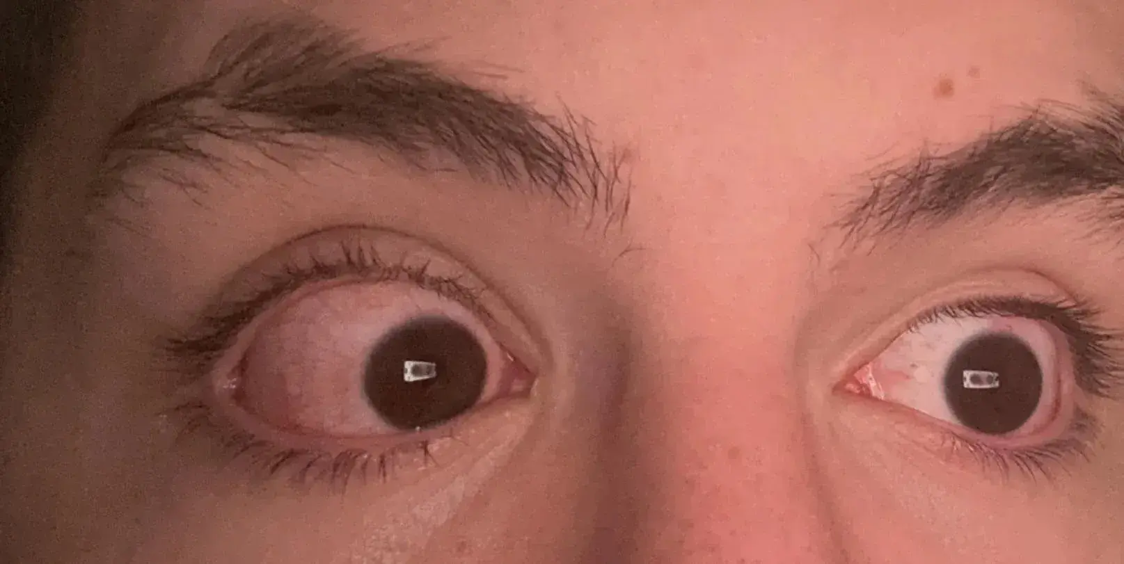 Close-up of a person's eyes showing red irritation after wearing contact lenses.