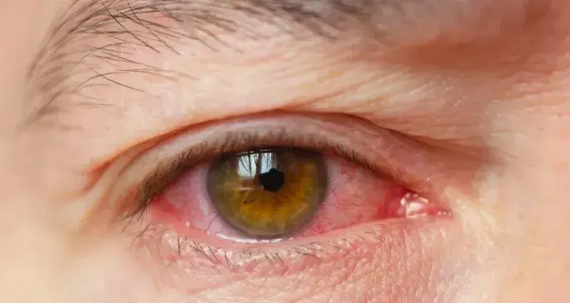 Close-up view of a red and irritated eye with yellowish iris.